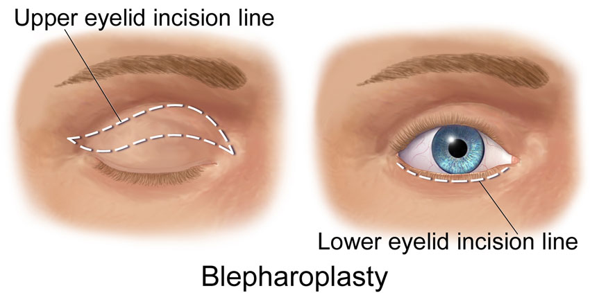 Eyelid surgery San Diego Blepharoplasty for medical and cosmetic